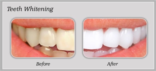 Smile Gallery Brite Smiles Dentistry dentist in Flower Mound, Tx Dr. Deepika Salguti DMD