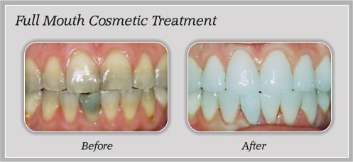 Cosmetic Dentistry Brite Smiles Dentistry dentist in Flower Mound, Tx Dr. Deepika Salguti DMD