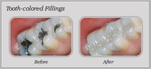 Composite Fillings Brite Smiles Dentistry dentist in Flower Mound, Tx Dr. Deepika Salguti DMD