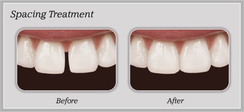 Smile Gallery Brite Smiles Dentistry dentist in Flower Mound, Tx Dr. Deepika Salguti DMD
