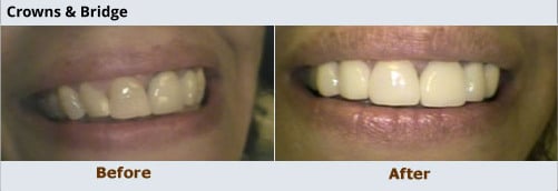Cosmetic Dentistry Brite Smiles Dentistry dentist in Flower Mound, Tx Dr. Deepika Salguti DMD