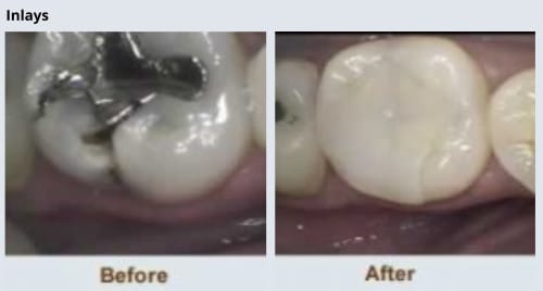 Cosmetic Dentistry Brite Smiles Dentistry dentist in Flower Mound, Tx Dr. Deepika Salguti DMD