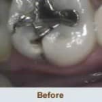 Inlays and Onlays Brite Smiles Dentistry dentist in Flower Mound, Tx Dr. Deepika Salguti DMD