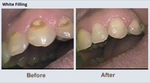 Cosmetic Dentistry Brite Smiles Dentistry dentist in Flower Mound, Tx Dr. Deepika Salguti DMD