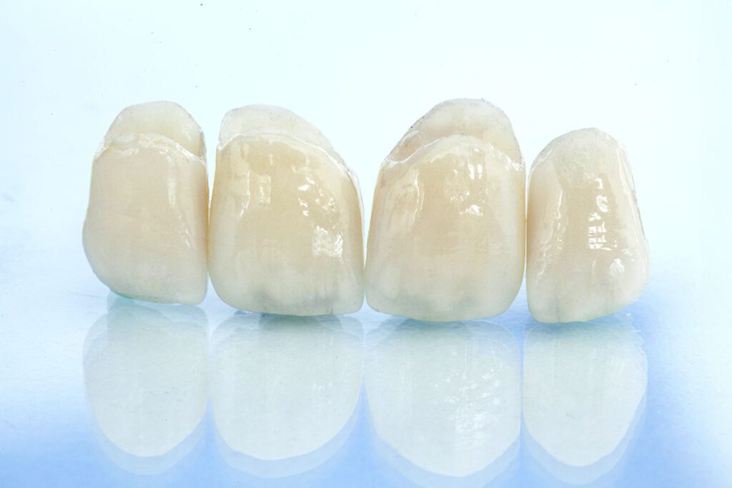 same-day crowns dental crowns cosmetic dentist in Flower Mound