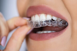 Your First Month with Invisalign: 7 Tips from a Cosmetic Dentist in Flower Mound
