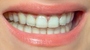 Invisalign in Flower Mound